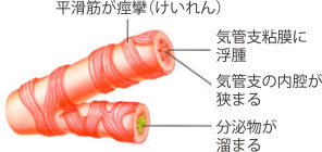 喘息発作を起こした気管支